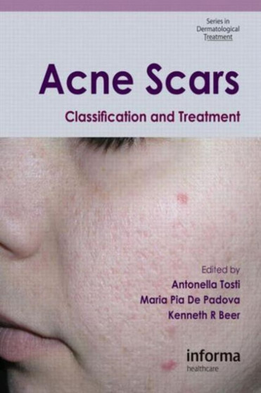 Acne Scars : Classification and Treatment by Antonella Tosti - Hardback