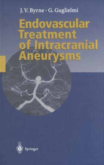 Endovascular Treatment of Intracranial Aneurysms by James Byrne - Paperback