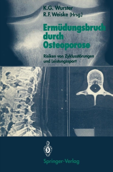 Ermudungsbruch durch Osteoporose : Risiken von Zyklusstoerungen und Leistungssport by Kurt G. Wurster - Paperback