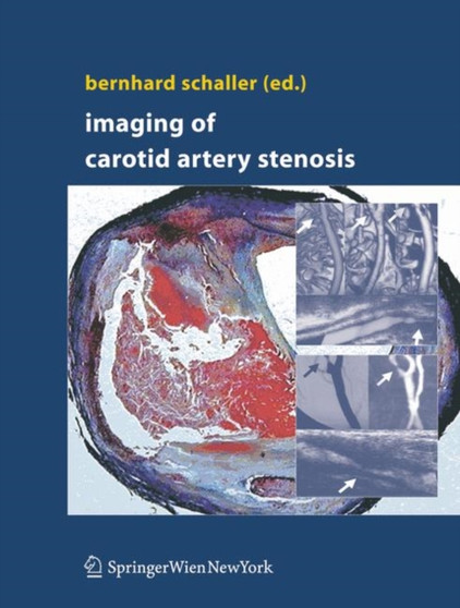 Imaging of Carotid Artery Stenosis by Bernhard Schaller - Hardback