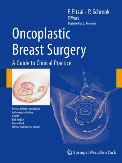 Oncoplastic Breast Surgery by Bernard Ammerer - Hardback