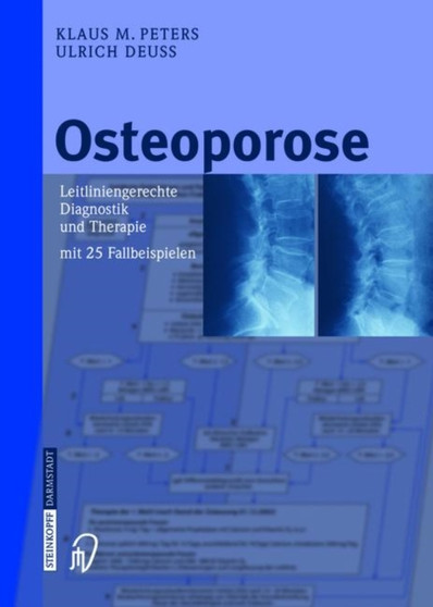 Osteoporose : Leitliniengerechte Diagnostik und Therapie mit 25 Fallbeispielen by Klaus M. Peters - Hardback