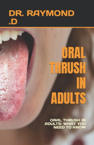 Oral Thrush in Adults : Oral Thrush in Adults: What You Need to Know
