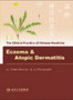 Eczema and Atopic Dermatitis by Chen Da-can - Paperback