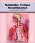Malignant Pleural Mesothelioma : A Guide for Clinicians by Antonio Giordano - Paperback