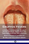 Eruptive Fevers : A History of Medicine - Scarlet Fever, Measles, Small-Pox and Treatments in the 19th Century - Being a Course of Lectures On by William Vallancey Drury - Paperback