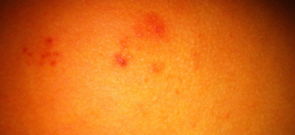 Treat Molluscum Contagiosum in Adults and Children. Natural Products