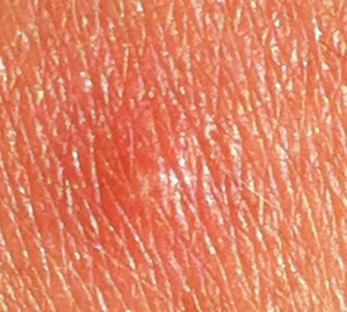 Molluscum Contagiosum at Home Treatment for Adults Molluscum Treat