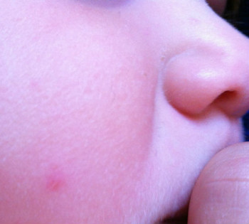Children often catch molluscum bumps from other children. While under the arms and in the arm pit is the most common location for mollusca in children, molluscum on the face is especially problematic.