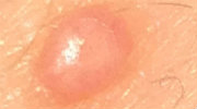 You don't need expensive ointments or creams to treat molluscum contagiosum. There is a natural home remedy that works - one that can be used on adults and is mild enough to treat infants and children.