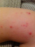 Molluscum warts and eczema before treatment with molluscum contagiosum home remedies.