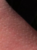 The pearly white heads of a cluster of beginning stage molluscum contagiosum. This cluster was approximately 5 cm (2 inches) square and consisted of over 200 individual bumps. 