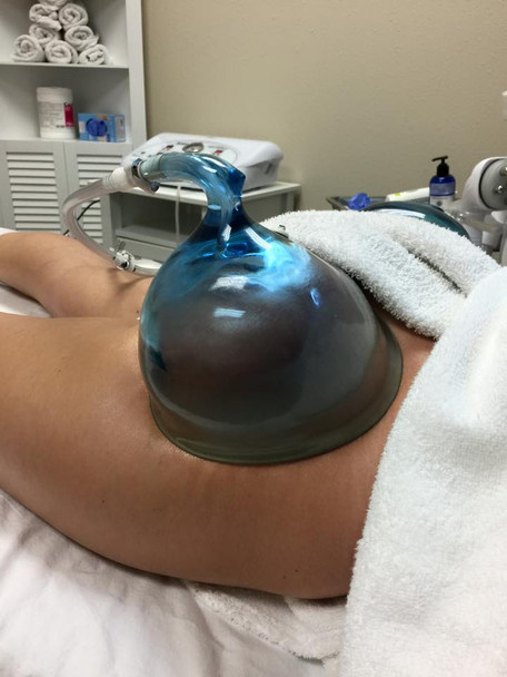 These suction cups simultaneously placed on the buttocks is able to correct and tone the gluteal muscles. This wonderful body enhancement kit includes two cups and a hose connection on Y. which connects to your cavitation machine.
Place the cups on the buttocks, leaving them fixed for a period of 40 minutes, keeping the pressure medium or low – according to patient comfort and the discretion (this depends on the tone of the buttock) – and system using pulse frequency.
These cups are made of a transparent material that allows the therapist to visualize the effect of suction monitor treatment and ensure quality. The procedure is painless and should not cause any traumatic effect to the skin.