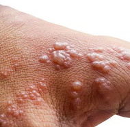 Emu Oil and ​Viral Rashes – Monkeypox, Shingles, Chickenpox, Molluscum Contagiosum, COVID-19 and more ...