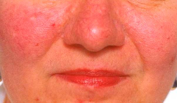 Rosacea Image