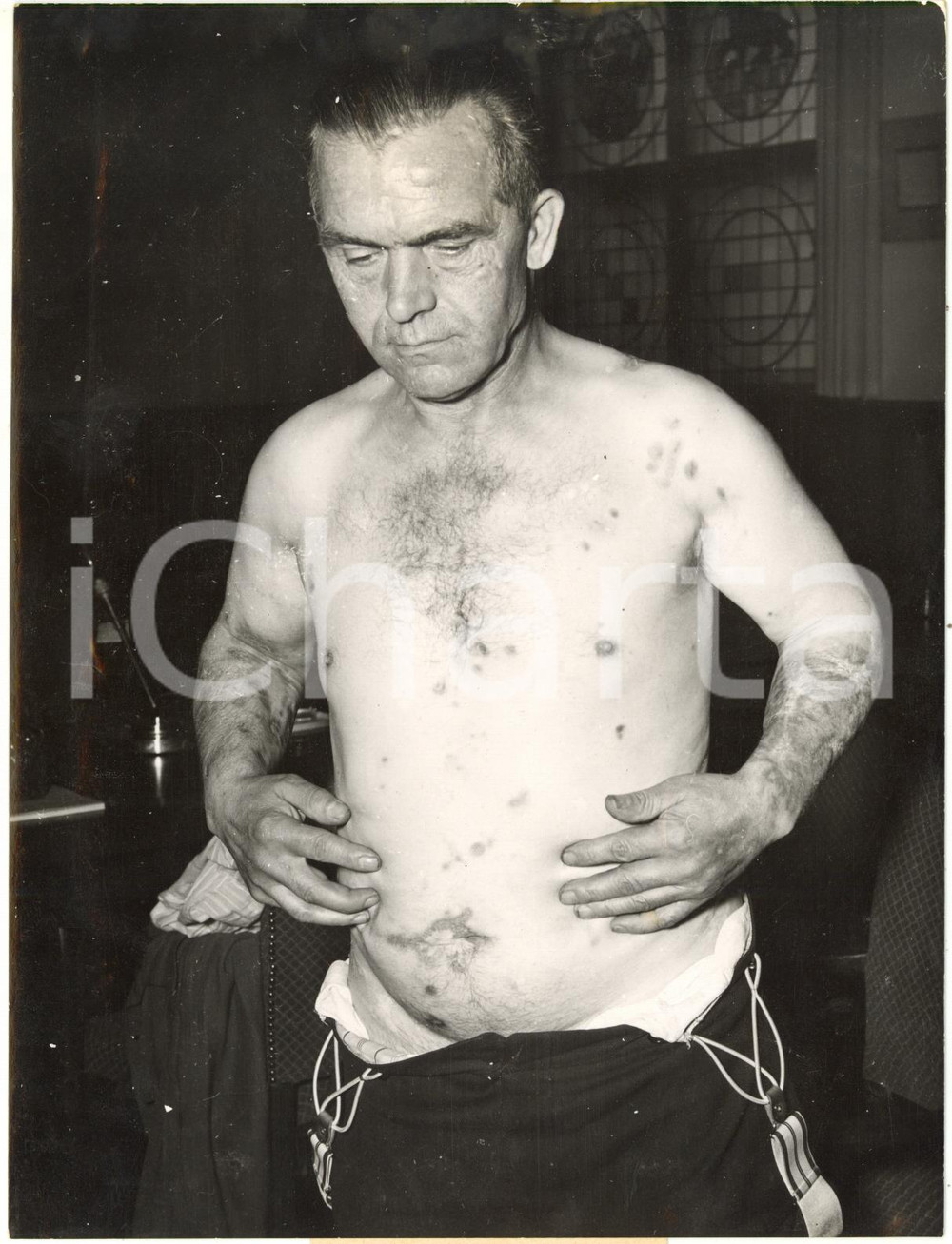 1953 GERMANY Ex-prigioniero Friedrich JADICKE mostra segni di torture sovietiche