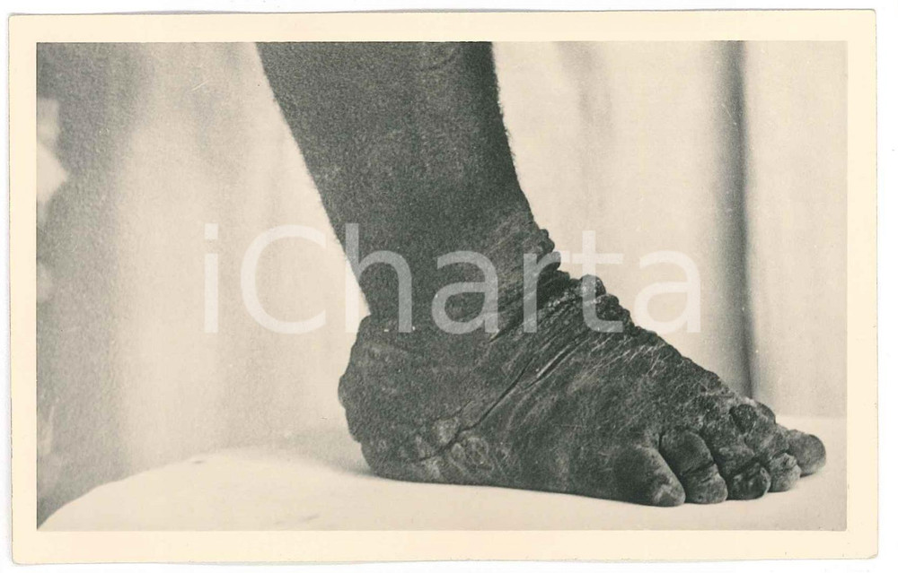 1930 ca C. ZAGOURSKI «L'Afrique qui disparaît» Maladies tropicales 163A 1  Fotocartolina postale d'epoca, appartenente alla serie &laquo;L'Afrique qui dispara&icirc;t&raquo; del fotografo Casimir Zagourski (L&eacute;opoldville),N&deg;163A, non viaggiata.Al verso timbro: "Henri Nicaise Photographe - Namur"CONDIZIONI: GFORMATO: 9x14 cm    originale e autentica 1