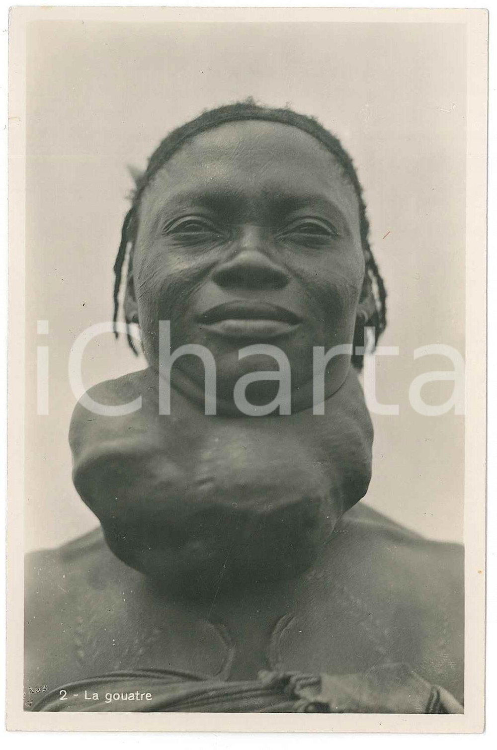 1930 ca ZAGOURSKI «L'Afrique qui disparaît» Maladies tropicales: le goitre (1)  Fotocartolina postale d'epoca, appartenente alla serie &laquo;L'Afrique qui dispara&icirc;t&raquo; del fotografo Casimir Zagourski (L&eacute;opoldville).N&deg; 164, non viaggiata.CONDIZIONI: GFORMATO: 9x14 cm     originale e autentica 1