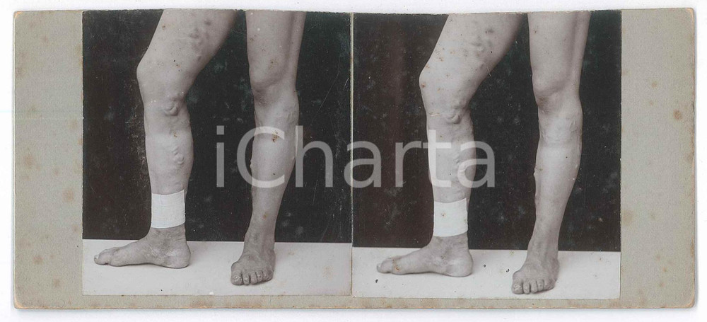 1910 ca Skin DISEASES - Legs - RARE MEDICAL Stereoview Fotografia stereoscopica d'epoca, su cartoncino rigido. POOR/danneggiato rifilata al margine superiore; fioriture Formato: 18x9 cm originale e autentica 1