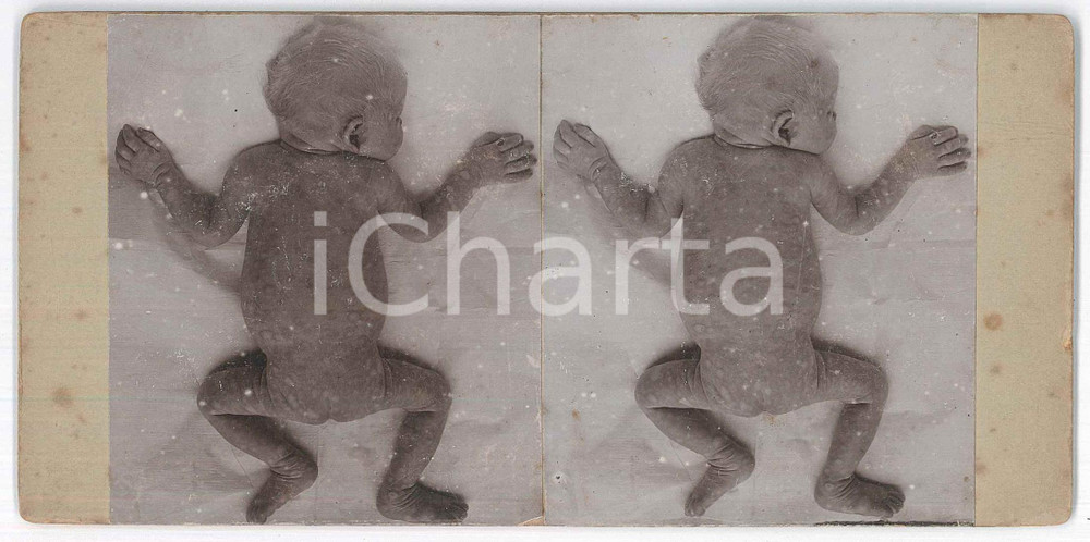 1910 ca DISEASES - ODDITIES - Abortion - RARE MEDICAL Stereoview (1) Fotografia stereoscopica d'epoca, su cartoncino rigido. FAIR/discreto fioriture Formato: 18x9 cm originale e autentica 1