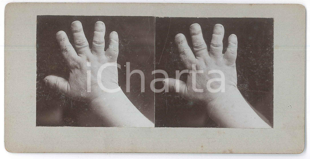 1910 ca DISEASES - ODDITIES - Hand  *RARE MEDICAL Stereoview (2) Fotografia stereoscopica d'epoca, su cartoncino rigido. FAIR/discreto graffi Formato: 18x9 cm originale e autentica 1