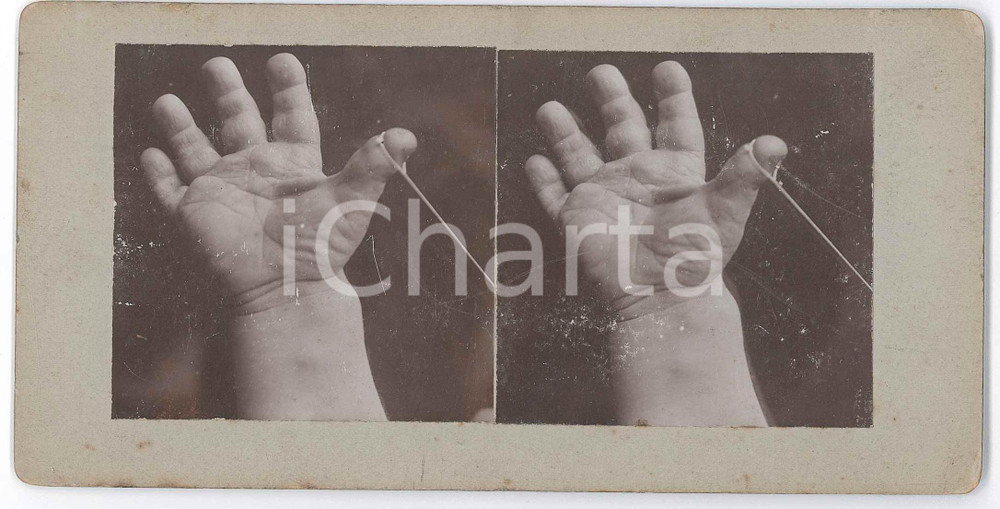 1910 ca DISEASES - ODDITIES - Hand  *RARE MEDICAL Stereoview (1) Fotografia stereoscopica d'epoca, su cartoncino rigido. FAIR/discreto lievi abrasioni Formato: 18x9 cm originale e autentica 1