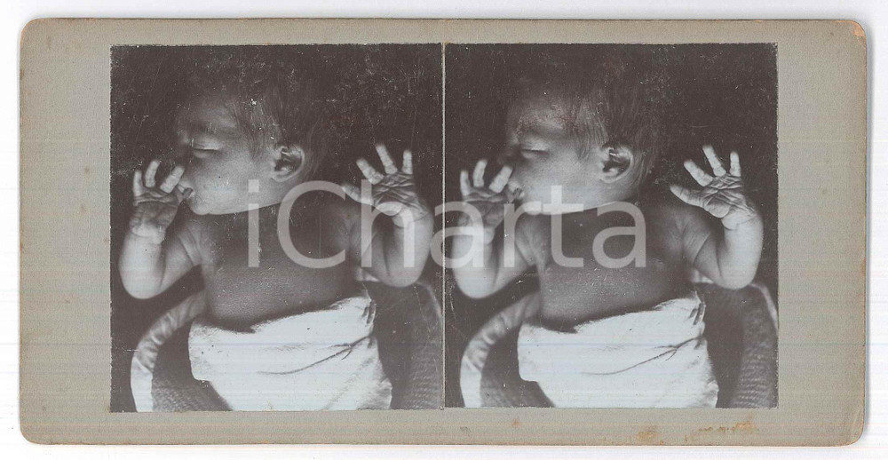 1910 ca DISEASES - ODDITIES - Newborn - RARE MEDICAL Stereoview (1) Fotografia stereoscopica d'epoca, su cartoncino rigido. GOOD/buono  Formato: 18x9 cm originale e autentica 1