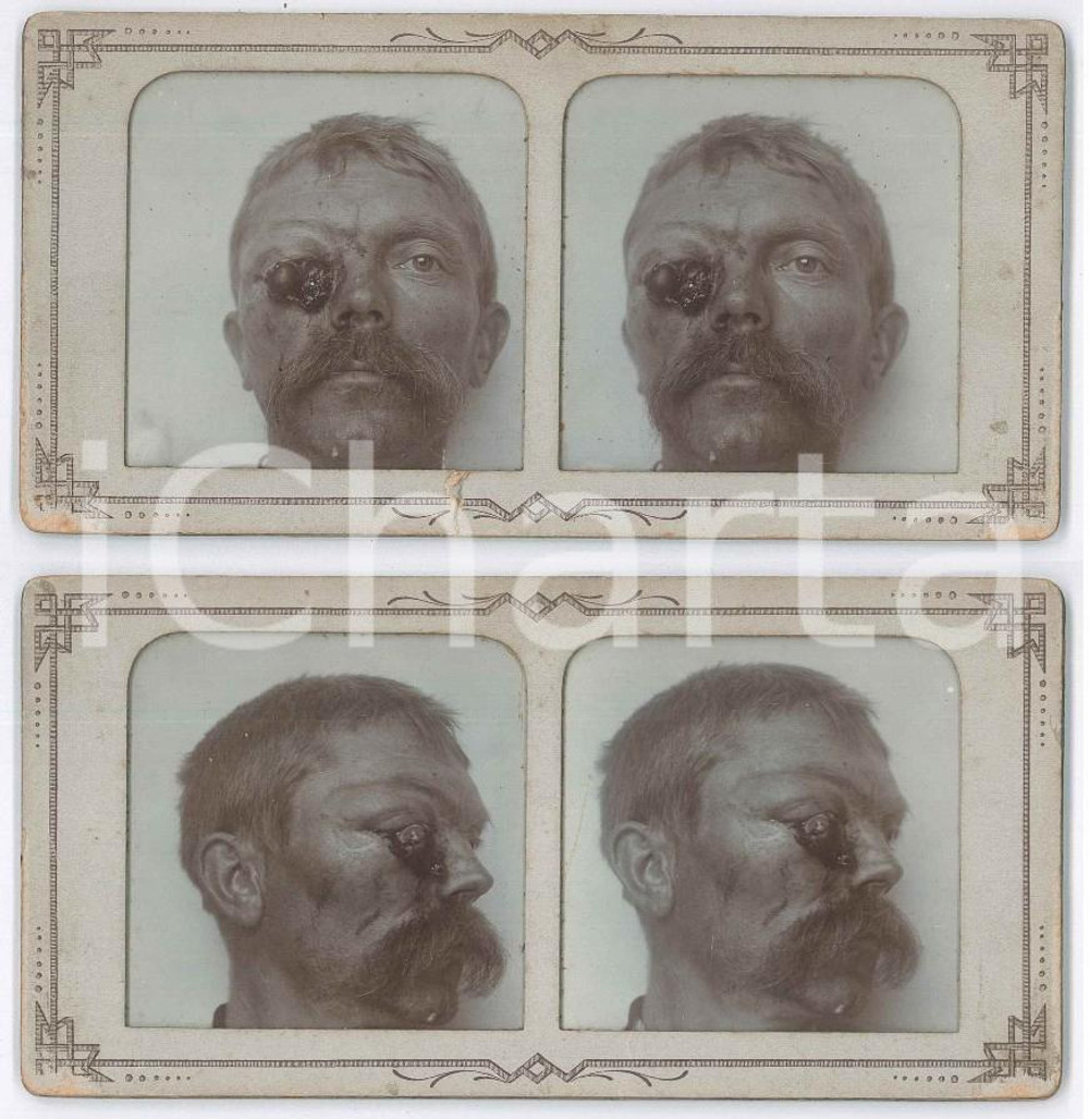 1910 ca DISEASES - Ophtalmology - Man  *RARE MEDICAL Stereoview 4 photos Fotografia stereoscopica d'epoca, su cartoncino rigido.Presenti due immagini per lato. GOOD/buono  Formato: 18x9 cm originale e autentica 1