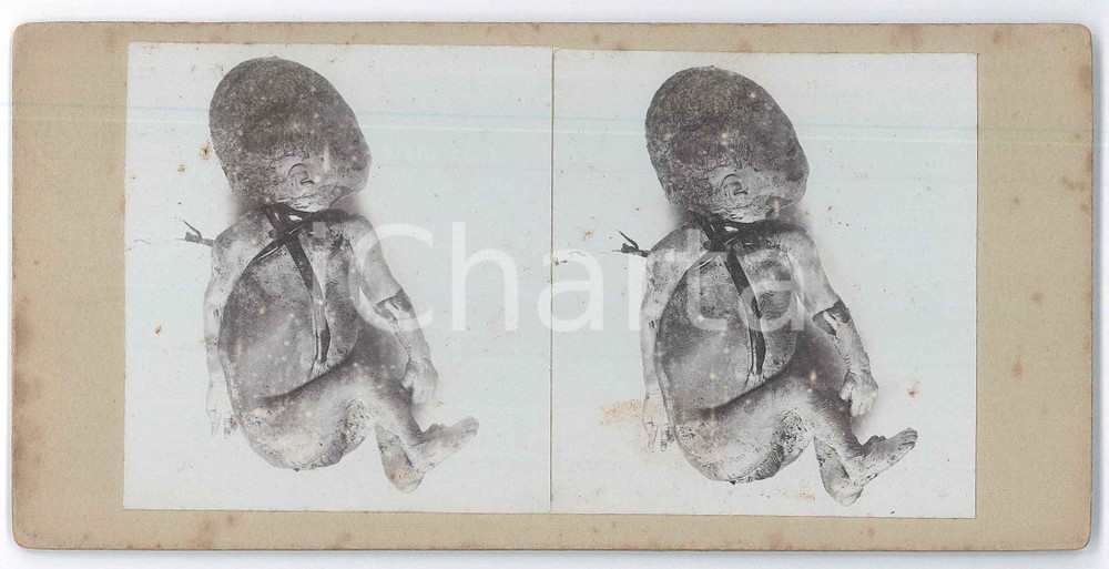 1910 ca DISEASES - ODDITIES - Abortion - Foetuses - RARE MEDICAL Stereoview (2) Fotografia stereoscopica d'epoca, su cartoncino rigido. FAIR/discreto fioriture Formato: 18x9 cm originale e autentica 1