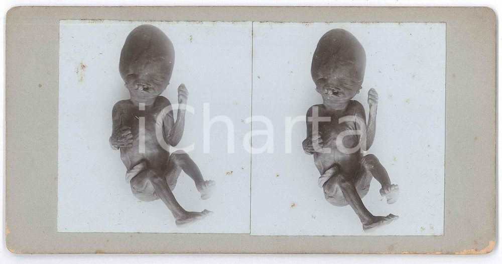 1910 ca DISEASES - ODDITIES - Abortion - Foetuses - RARE MEDICAL Stereoview (1) Fotografia stereoscopica d'epoca, su cartoncino rigido. FAIR/discreto fioriture Formato: 18x9 cm originale e autentica 1