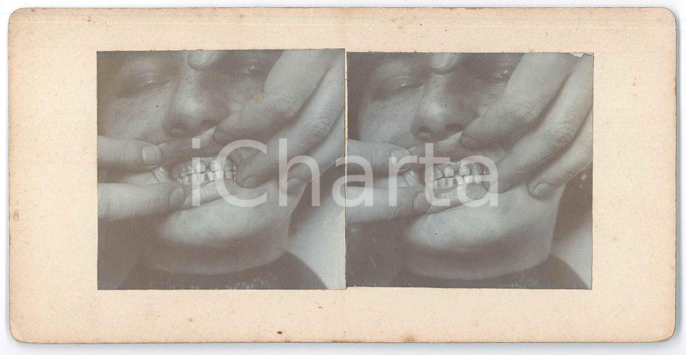 1910 ca DISEASES - ODDITIES - Teeth - RARE MEDICAL Stereoview Fotografia stereoscopica d'epoca, su cartoncino rigido. GOOD/buono  Formato: 18x9 cm originale e autentica 1