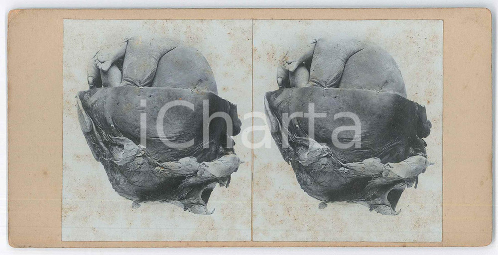 1910 ca DISEASES - Abortion - Foetuses - RARE MEDICAL Stereoview (3) Fotografia stereoscopica d'epoca, su cartoncino rigido. POOR/danneggiato fioriture Formato: 18x9 cm originale e autentica 1