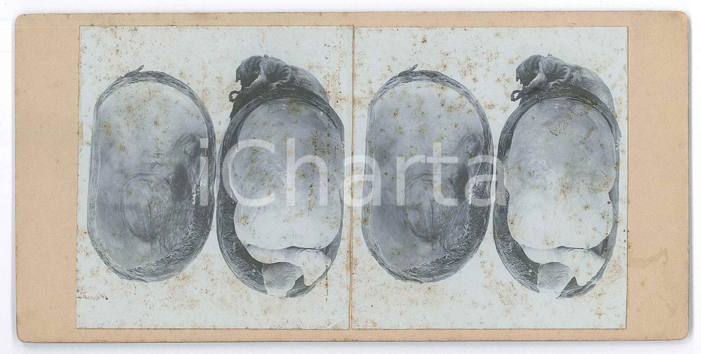 1910 ca DISEASES - Abortion - Foetuses - RARE MEDICAL Stereoview (2) Fotografia stereoscopica d'epoca, su cartoncino rigido. POOR/danneggiato fioriture Formato: 18x9 cm originale e autentica 1