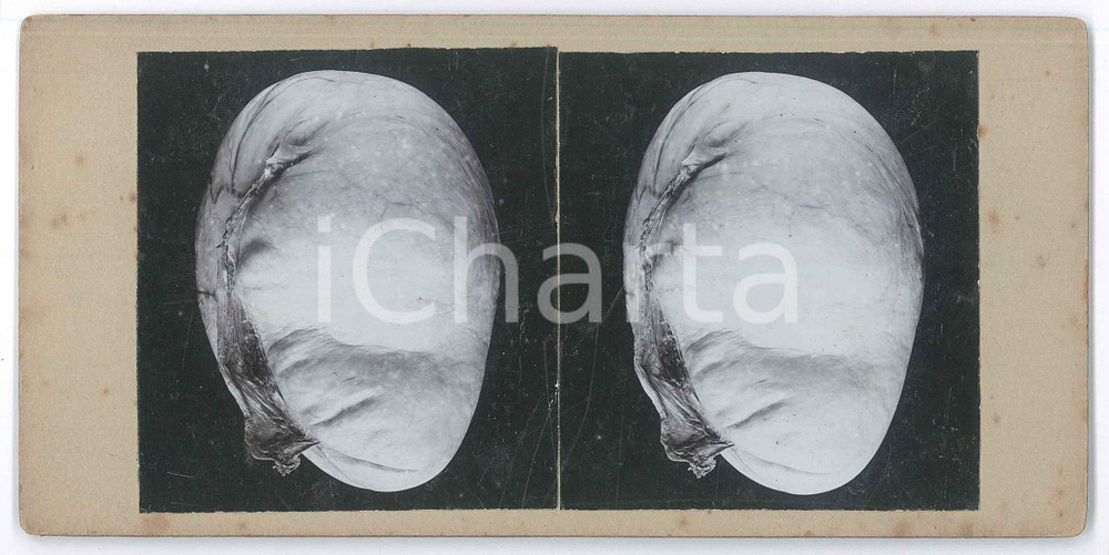 1910 ca DISEASES - Abortion - Foetuses - RARE MEDICAL Stereoview (1) Fotografia stereoscopica d'epoca, su cartoncino rigido. GOOD/buono  Formato: 18x9 cm originale e autentica 1