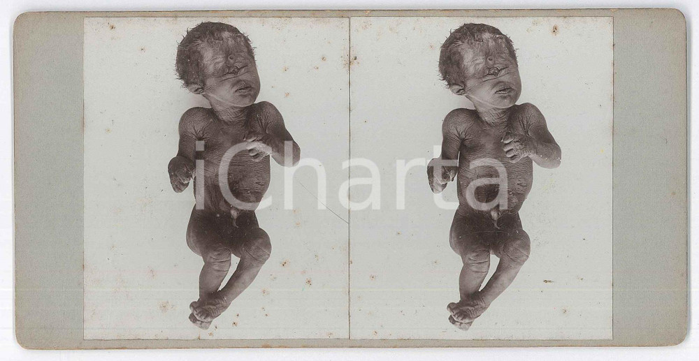 1910 ca DISEASES - ODDITIES - Children - RARE MEDICAL Stereoview (2) Fotografia stereoscopica d'epoca, su cartoncino rigido. FAIR/discreto fioriture Formato: 18x9 cm originale e autentica 1