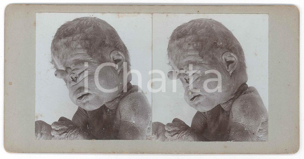 1910 ca DISEASES - ODDITIES - Children - RARE MEDICAL Stereoview (3) Fotografia stereoscopica d'epoca, su cartoncino rigido. FAIR/discreto minime abrasioni Formato: 18x9 cm originale e autentica 1