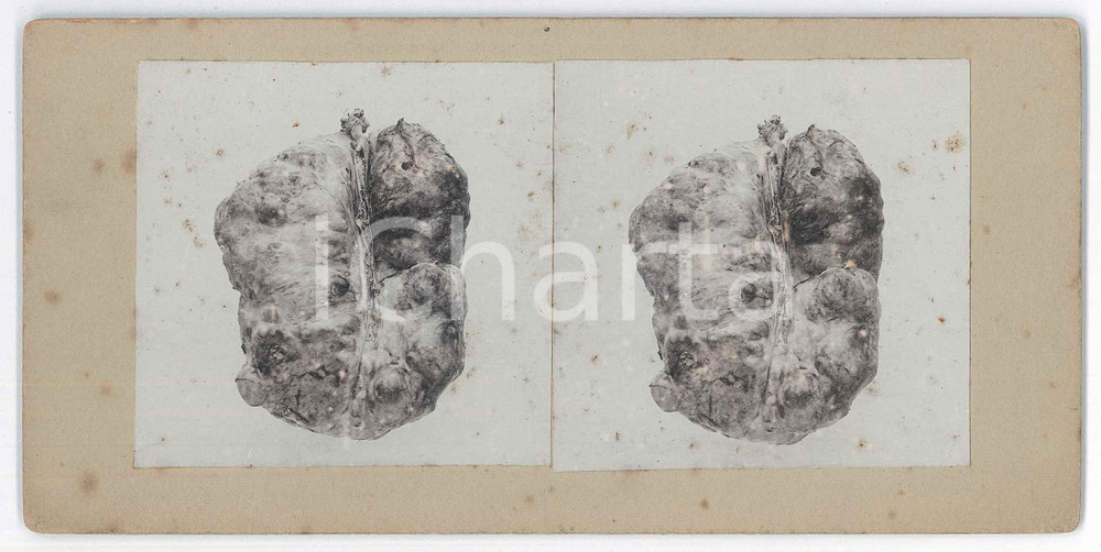 1910 ca AUTOPSIES - Human body - RARE MEDICAL Stereoview (8) Fotografia stereoscopica d'epoca, su cartoncino rigido. FAIR/discreto fioriture Formato: 18x9 cm originale e autentica 1