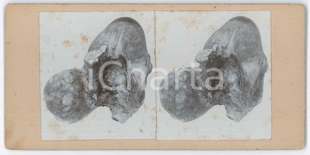1910 ca AUTOPSIES - Human body - RARE MEDICAL Stereoview (1) Fotografia stereoscopica d'epoca, su cartoncino rigido. FAIR/discreto fioriture Formato: 18x9 cm originale e autentica 1