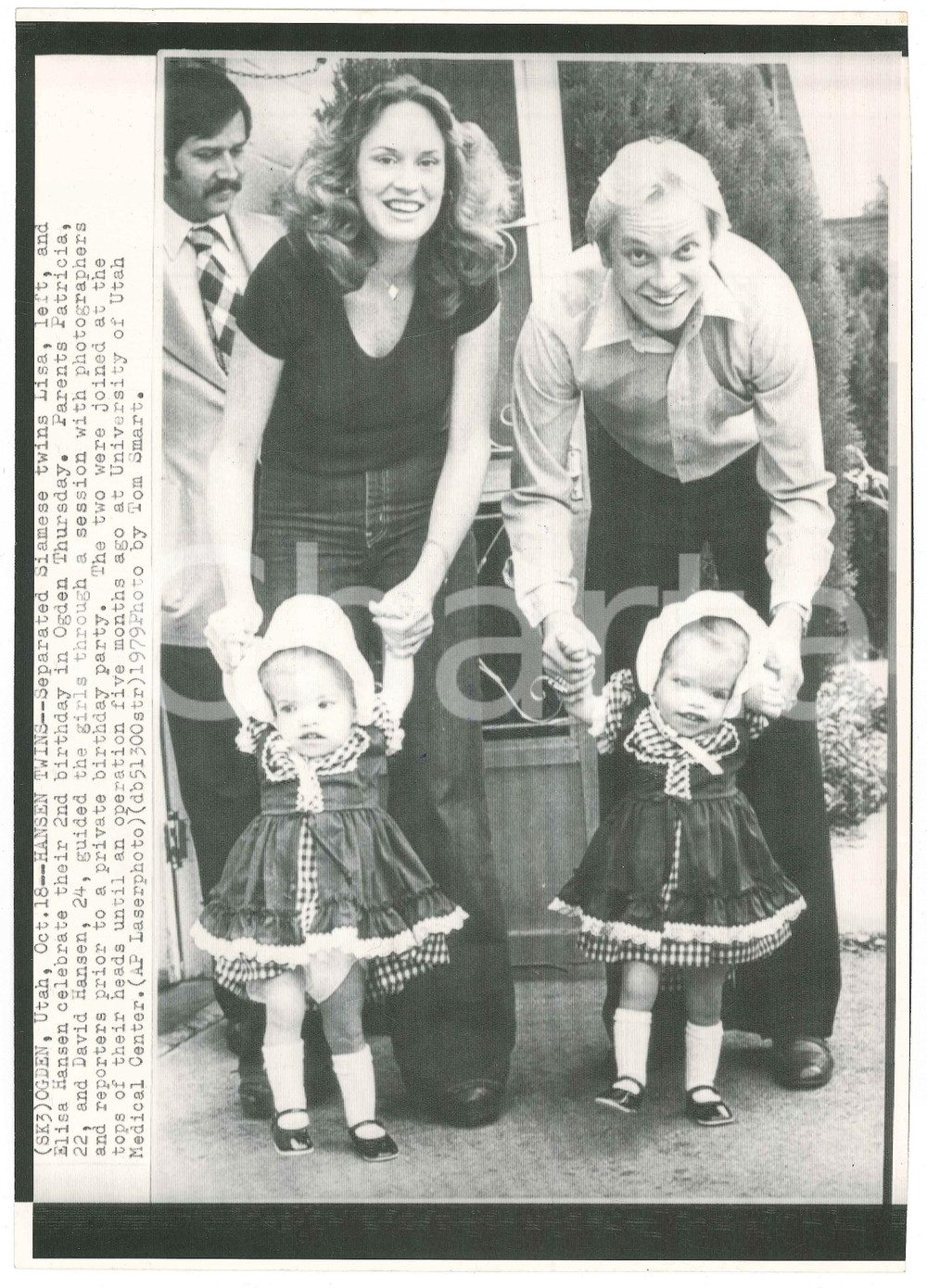 Fotografia d epoca originale 1979 OGDEN UTAH Separated Siamese twins  HANSEN Family Telefoto 1