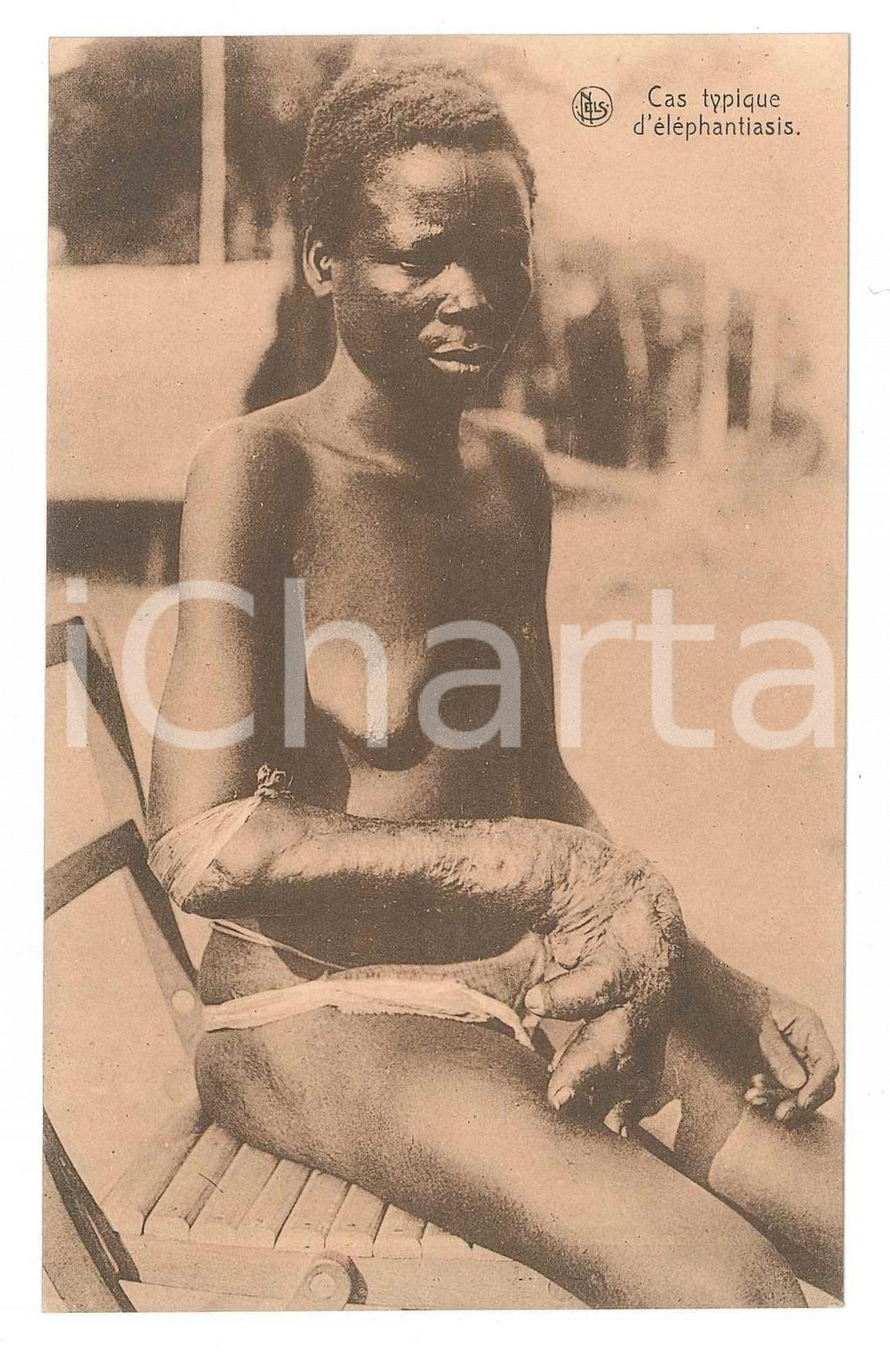 1930 ca AFRIQUE Cas typique d'éléphantiasis - Carte postale (3)  Cartolina d'epoca, non viaggiata. FAIR/discreto Lievi smussature agli angoli Formato: 14x9 originale e autentica 1