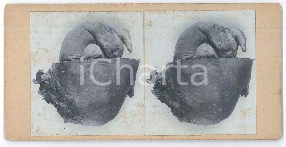 1910 ca DISEASES - Abortion - Foetuses - RARE MEDICAL Stereoview (4) Fotografia stereoscopica d'epoca, su cartoncino rigido. POOR/danneggiato fioriture Formato: 18x9 cm originale e autentica 1