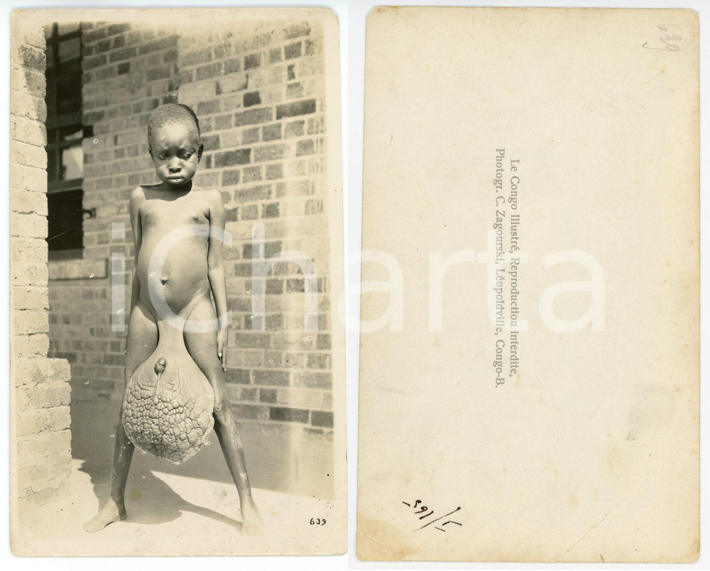 1930 ca C. ZAGOURSKI «L'Afrique qui disparaît» Elephantiasis - RPPC n.165  Fotocartolina postale d'epoca, appartenente alla serie &laquo;L'Afrique qui dispara&icirc;t&raquo; del fotografo Casimir Zagourski (L&eacute;opoldville), non viaggiata.CONDIZIONI: POOR (profonde piegature agli angoli, lievi strappi al margine superiore)FORMATO: 9x14 cm    originale e autentica 1