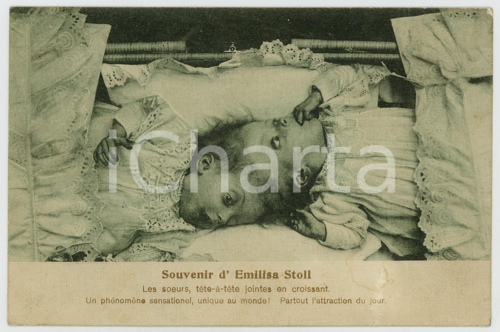 1910 ca  Emilisa STOLL Siamese twins conjoined at head ^French postcard  Cartolina postale d'epoca, non viaggiata.CONDIZIONI: POOR (piegatura al margine inferiore e lievi macchie)FORMATO: FP    originale e autentica 1