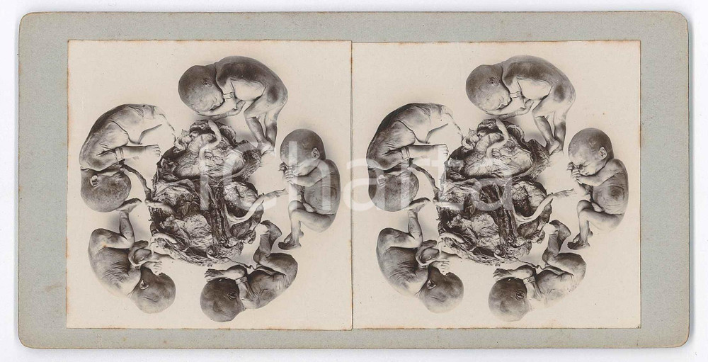 1910 ca DISEASES - Abortion - Foetuses *RARE MEDICAL Stereoview (5) Fotografia stereoscopica d'epoca, su cartoncino rigido. FAIR/discreto fioriture Formato: 18x9 cm originale e autentica 1
