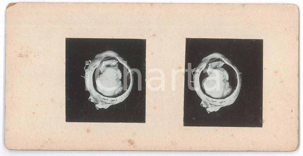 1910 ca AUTOPSIES Human body - RARE MEDICAL Stereoview (11) Fotografia stereoscopica d'epoca, su cartoncino rigido. FAIR/discreto fioriture; smussatura angolare Formato: 18x9 cm originale e autentica 1
