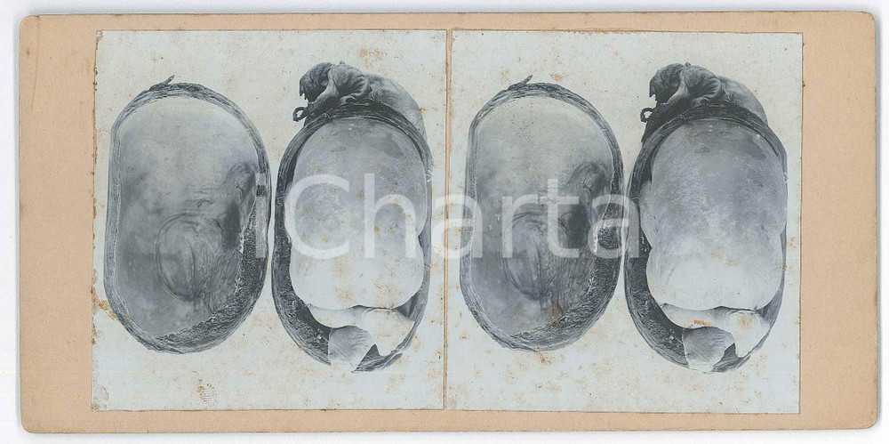 1910 ca DISEASES - Abortion - Foetuses *RARE MEDICAL Stereoview (2) Fotografia stereoscopica d'epoca, su cartoncino rigido. FAIR/discreto fioriture Formato: 18x9 cm originale e autentica 1
