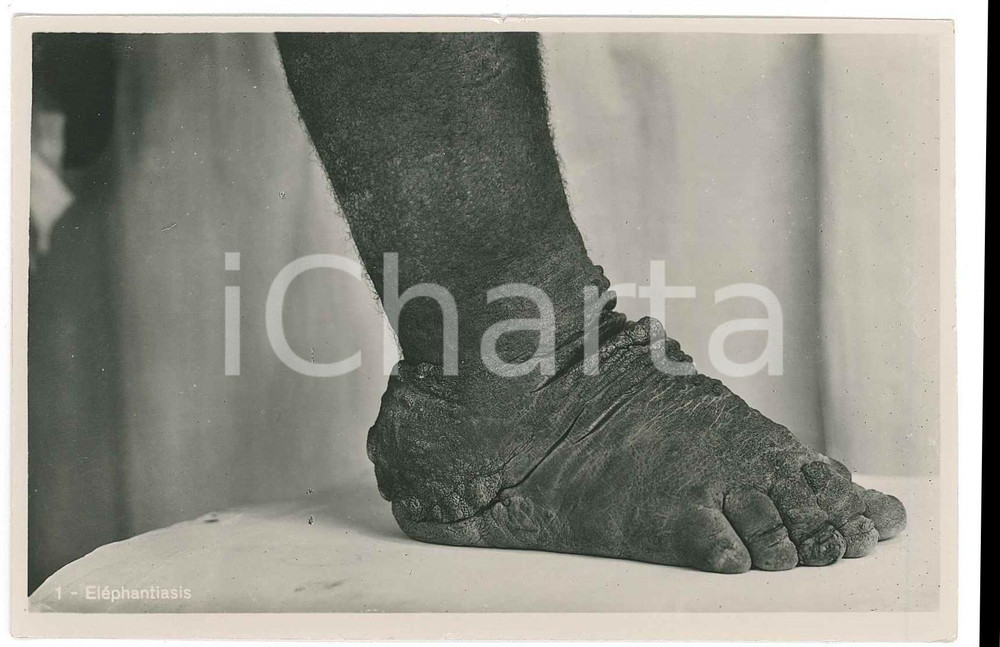 1930 ca C. ZAGOURSKI «L'Afrique qui disparaît Maladies tropicales 163A 2  Fotocartolina postale d'epoca, appartenente alla serie &laquo;L'Afrique qui dispara&icirc;t&raquo; del fotografo Casimir Zagourski (L&eacute;opoldville),N&deg;163A, non viaggiata.CONDIZIONI: GFORMATO: 9x14 cm    originale e autentica 1