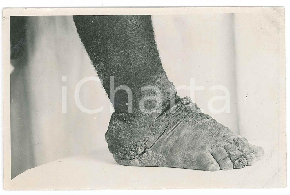 1930 ca C. ZAGOURSKI «L'Afrique qui disparaît» Maladies tropicales 163A 4  Fotocartolina postale d'epoca, appartenente alla serie &laquo;L'Afrique qui dispara&icirc;t&raquo; del fotografo Casimir Zagourski (L&eacute;opoldville),N&deg;163A, non viaggiata.CONDIZIONI: GFORMATO: 9x14 cm    originale e autentica 1