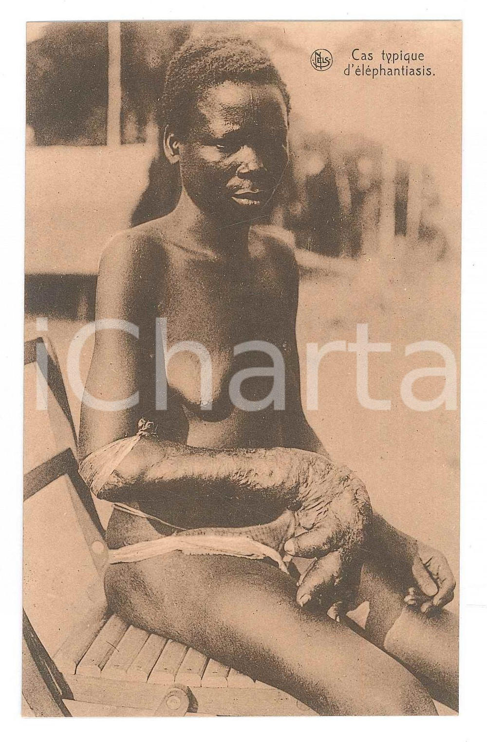 1930 ca AFRIQUE Cas typique d'éléphantiasis - Carte postale (5)  Cartolina d'epoca, non viaggiata. FAIR/discreto Lievi smussature agli angoli Formato: 14x9 originale e autentica 1
