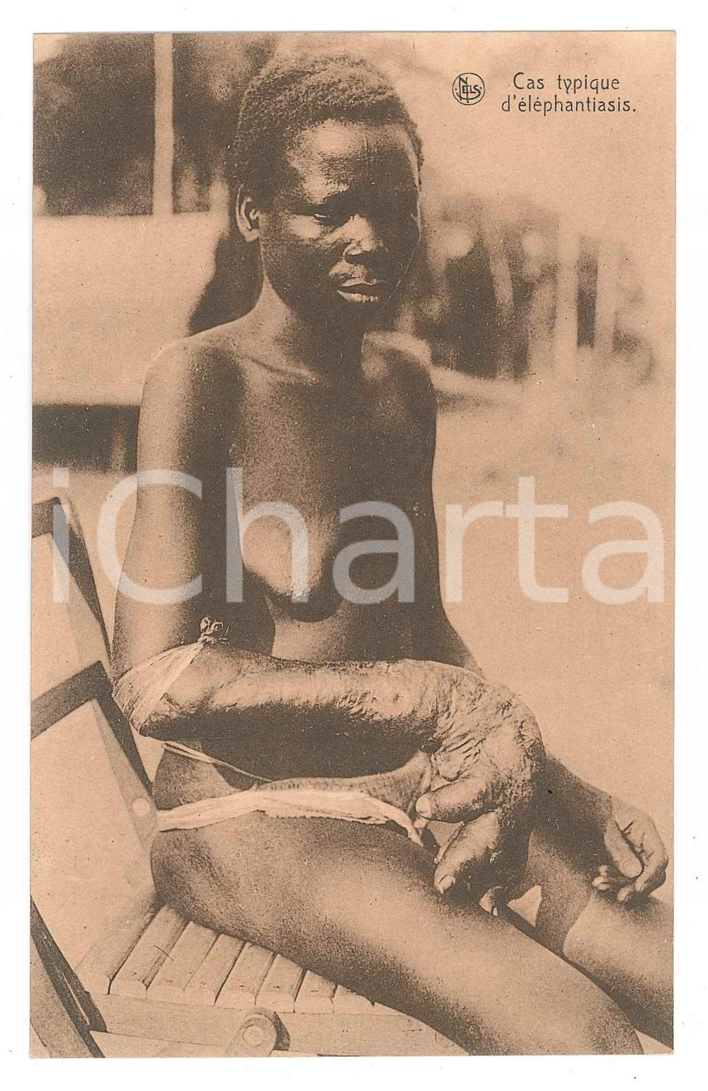 Cartolina originale da collezione 1930 ca AFRIQUE Cas typique d éléphantiasis  Carte postale 1 1